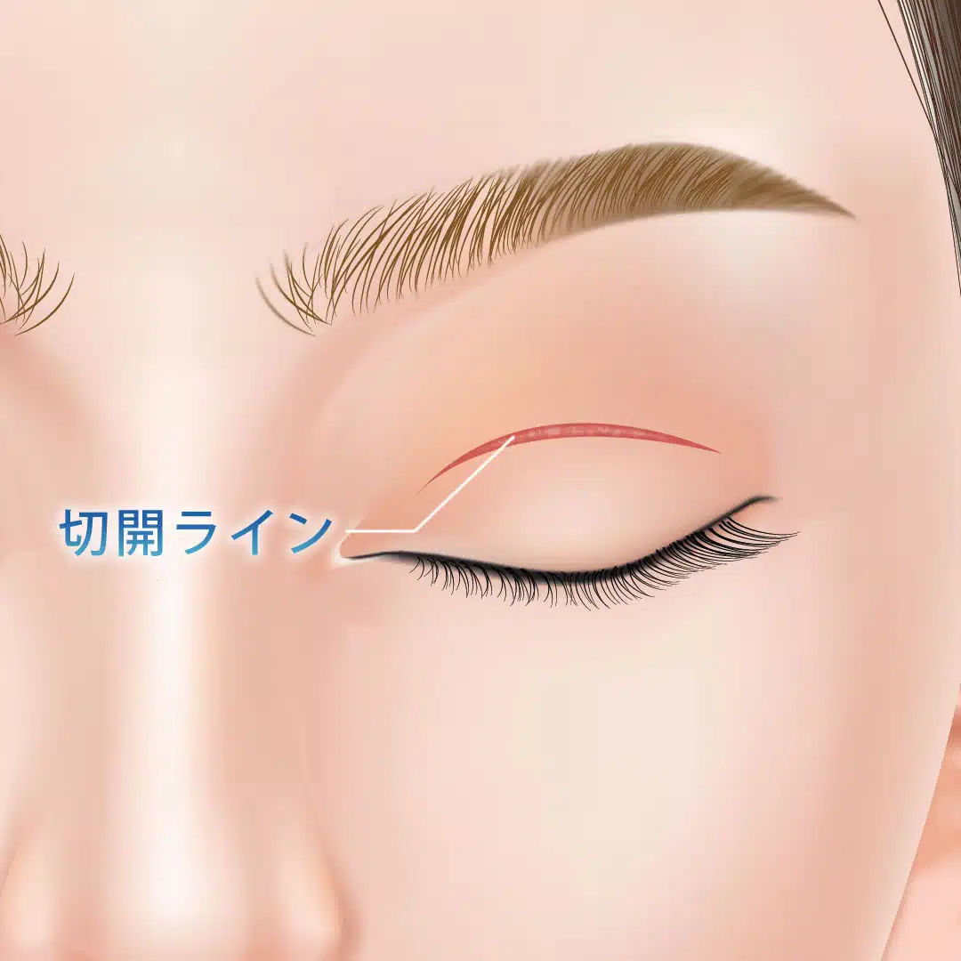 二重全切開