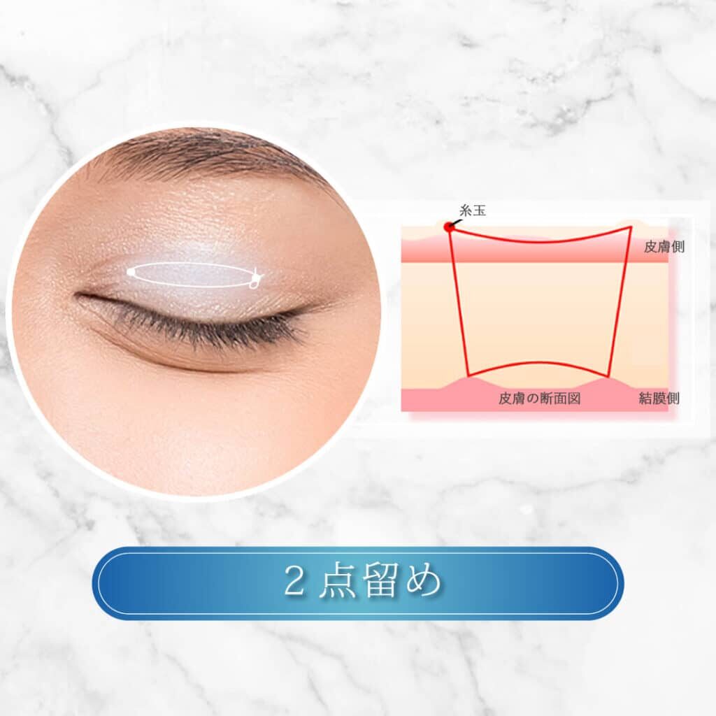 埋没法2点留め