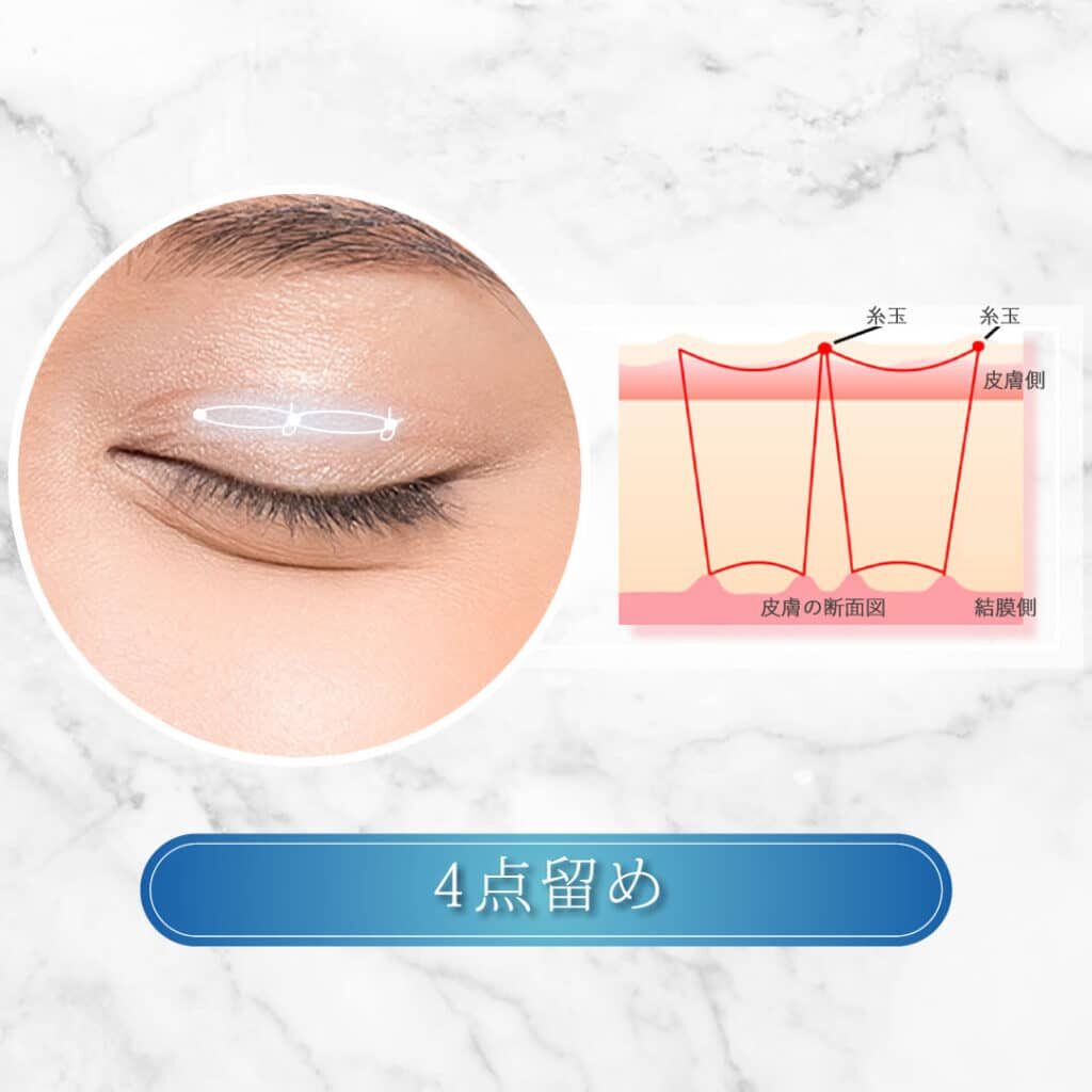 埋没法4点留め