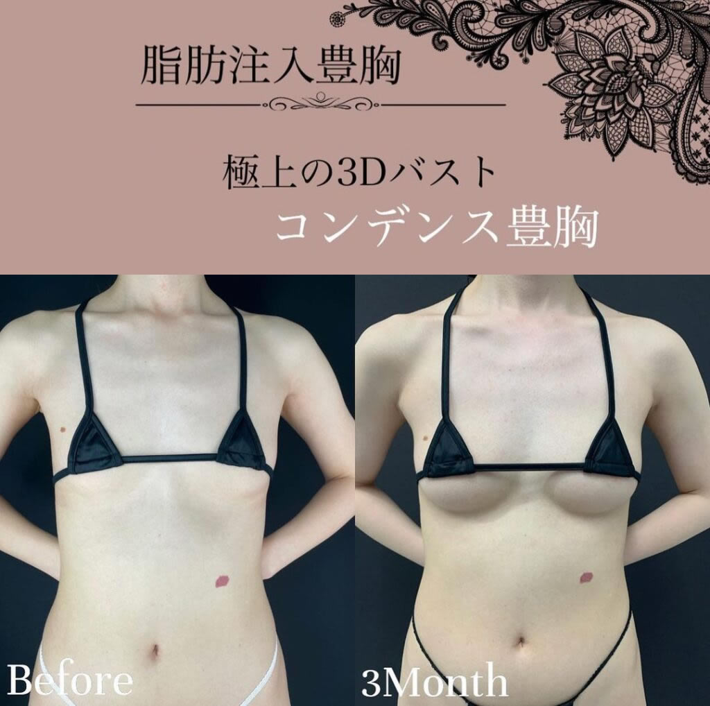 正面から見た３か月後のコンデンス豊胸の症例写真