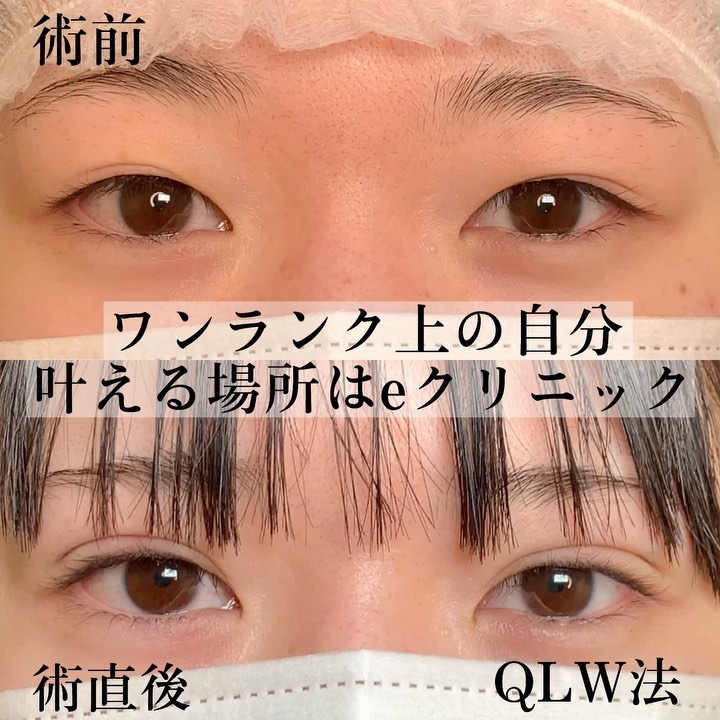 eclinic東京院の埋没法(クイックループダブル)