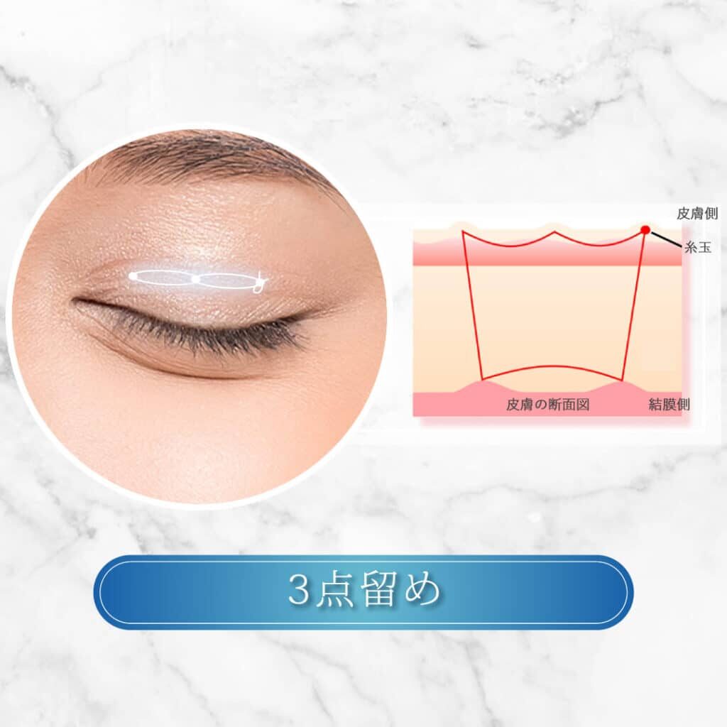 埋没法3点留め