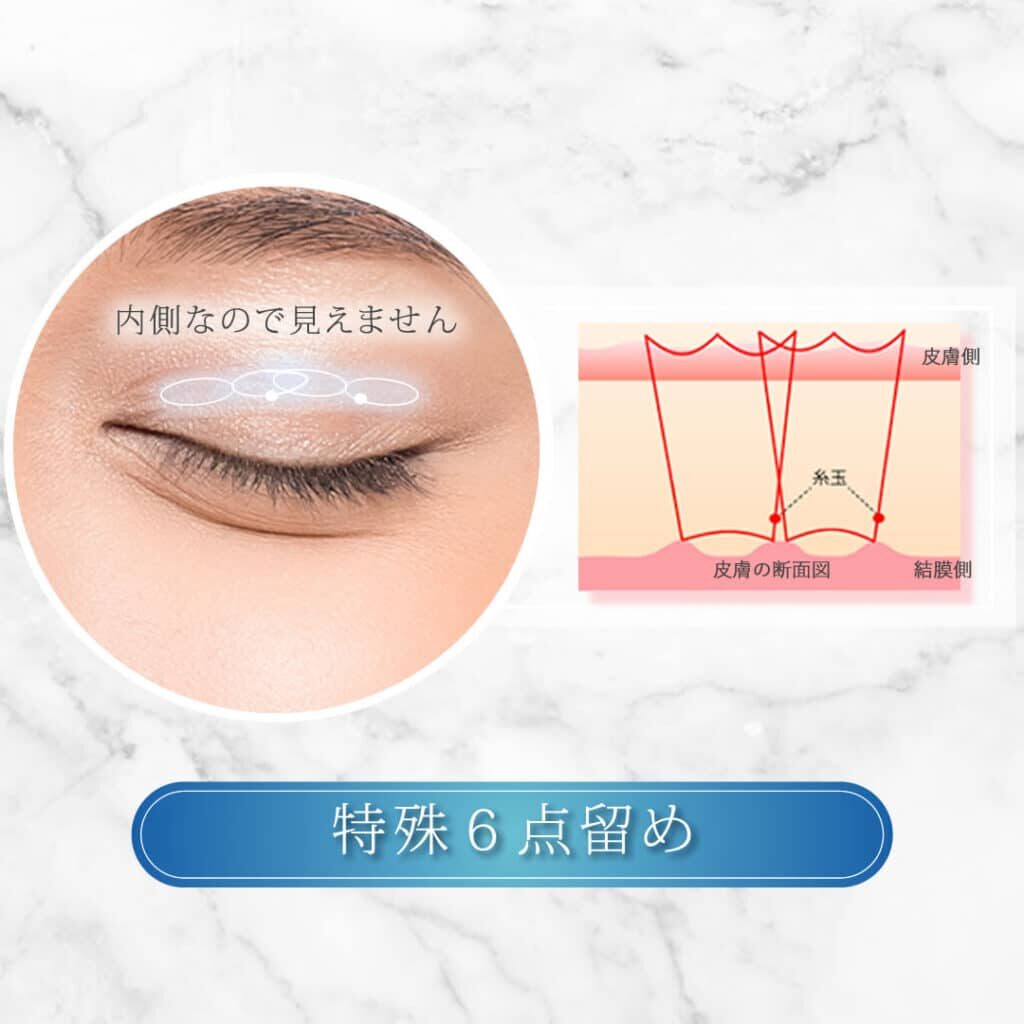 埋没法 特殊6点留め
