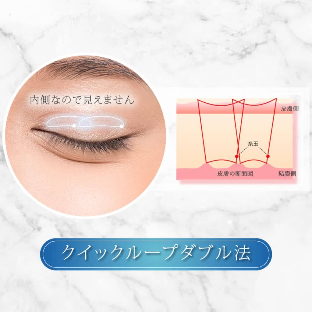 埋没法 クイックダブルループ