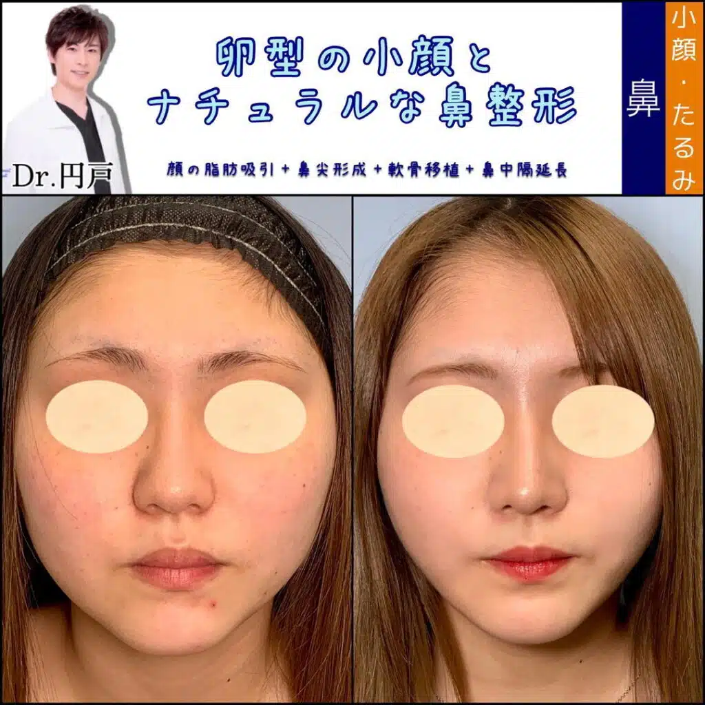 鼻尖形成