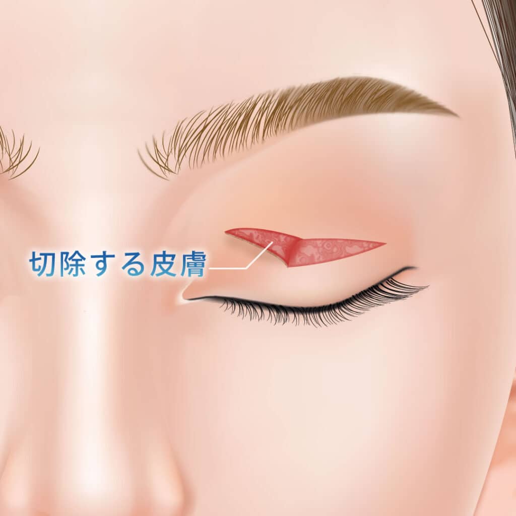 全切開二重術の手術方法_皮膚切除