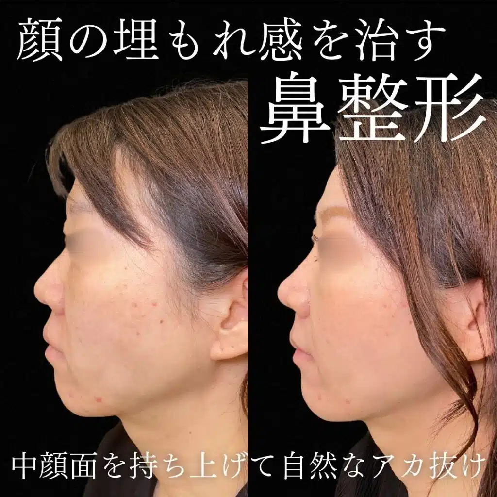 鼻尖形成