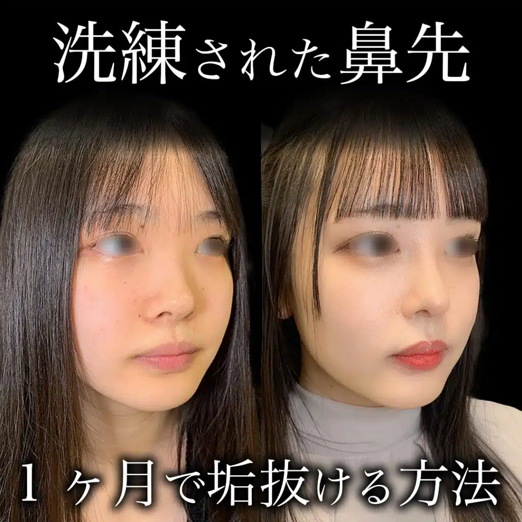 鼻尖形成