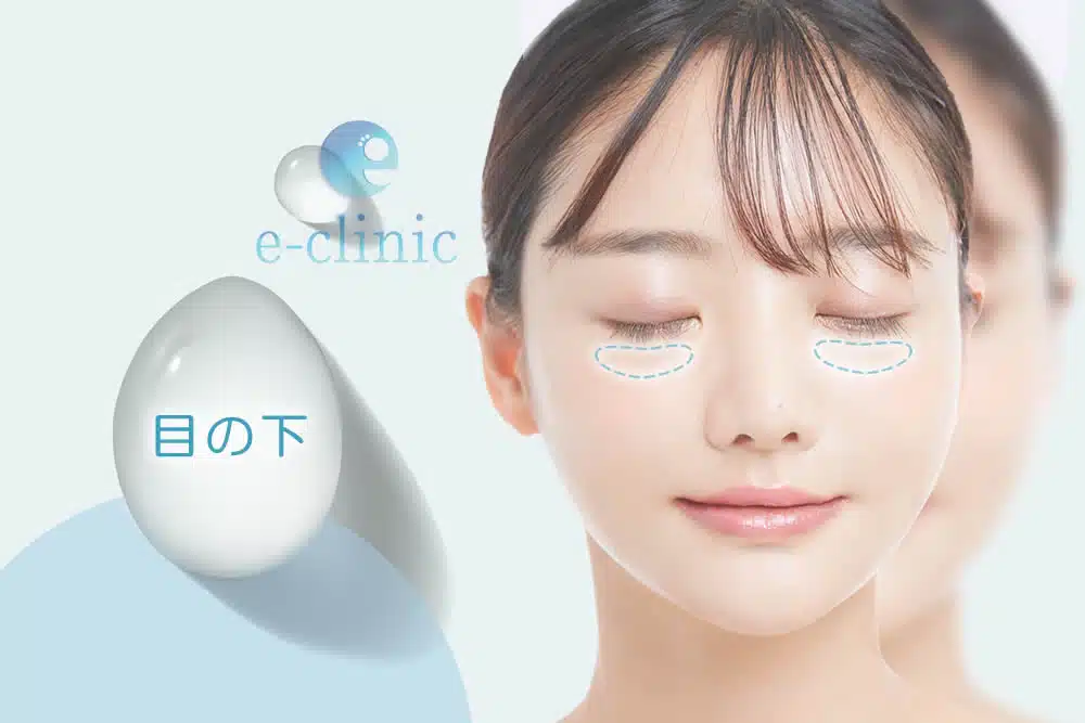 目の下 ヒアルロン酸