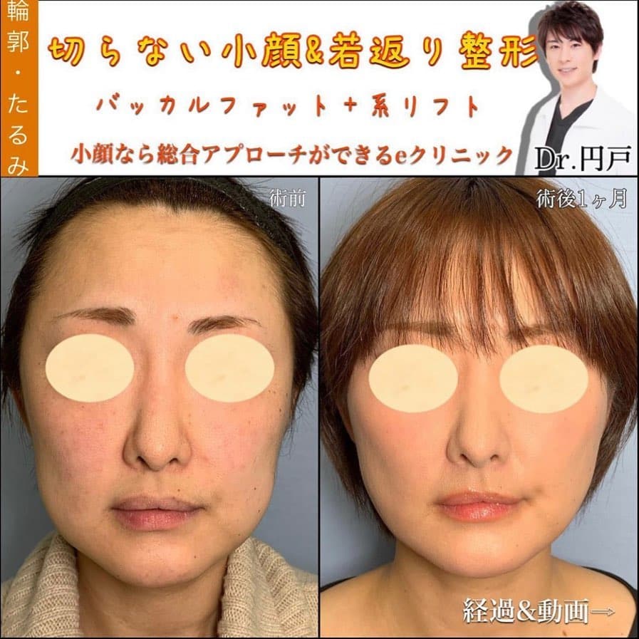 バッカルファット除去＋糸リフトの症例写真