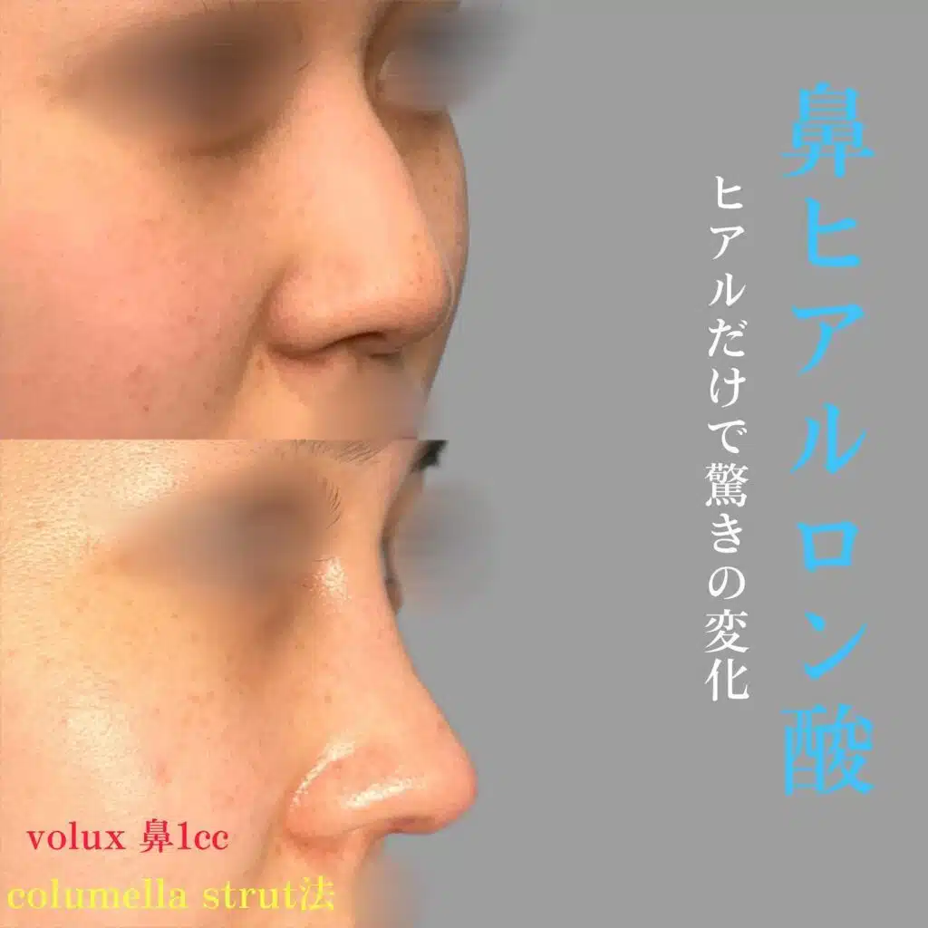 鼻 ヒアルロン酸