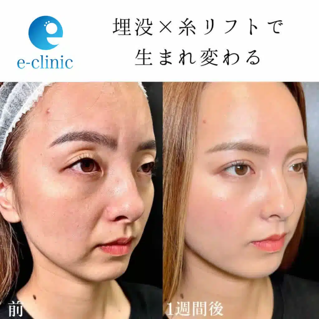 埋没＋糸リフトの症例写真