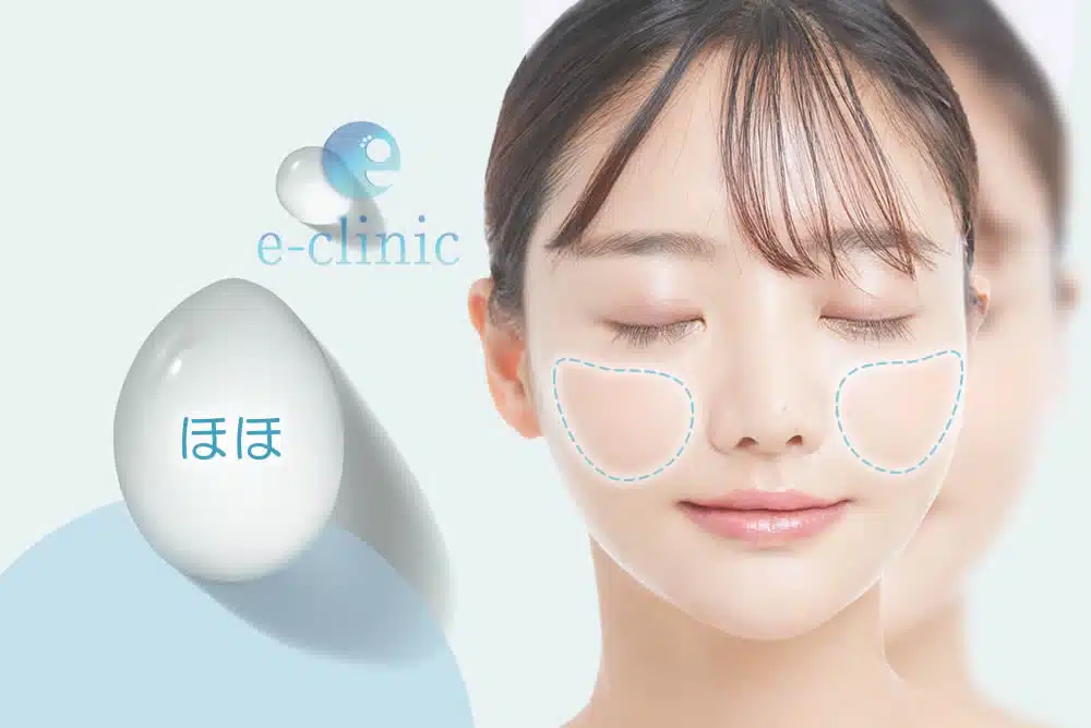 頬 ヒアルロン酸