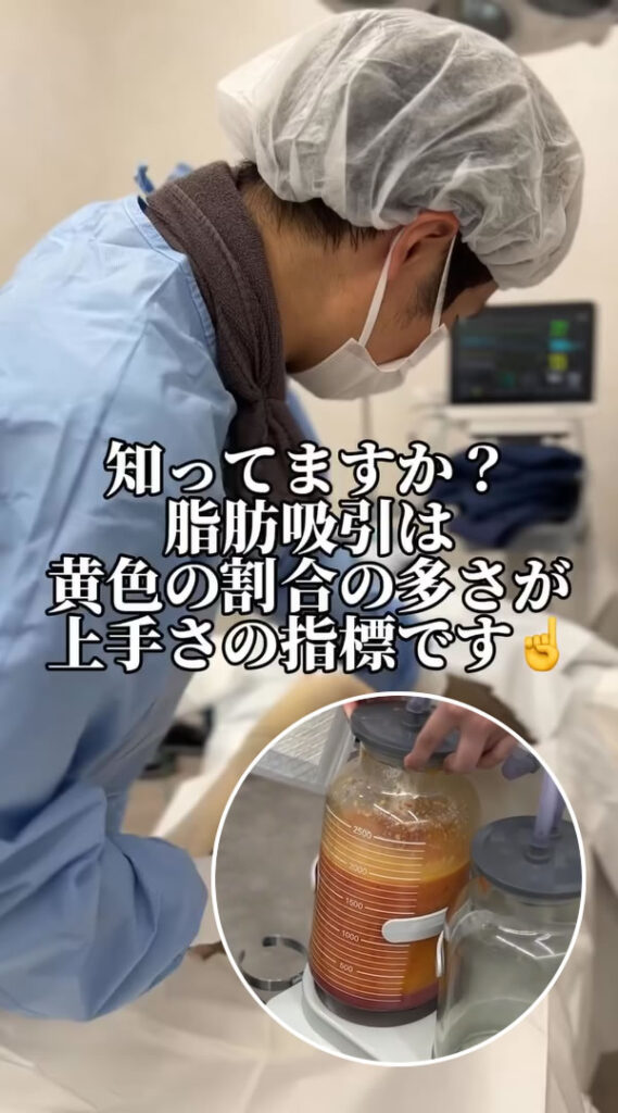 アキーセル脂肪吸引をしているところ
