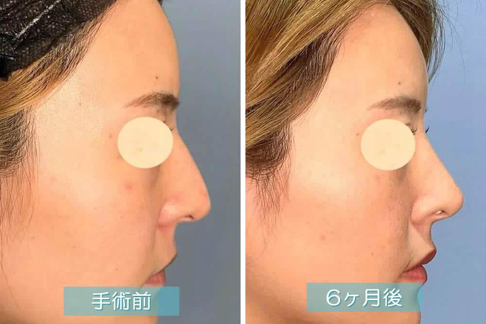 わし鼻修正の症例写真