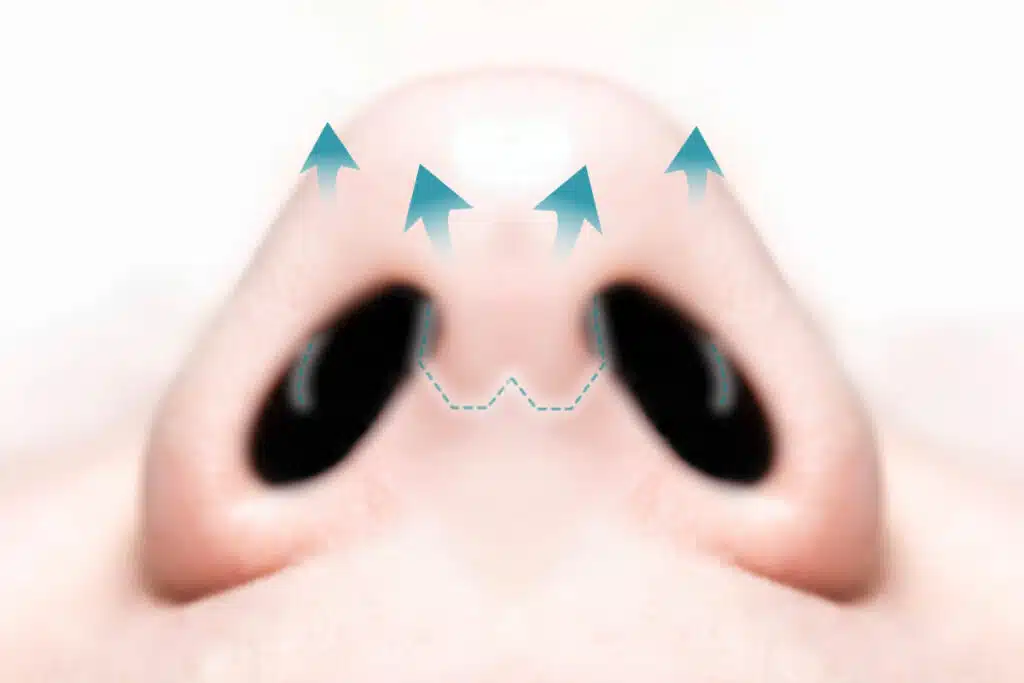 鼻尖形成