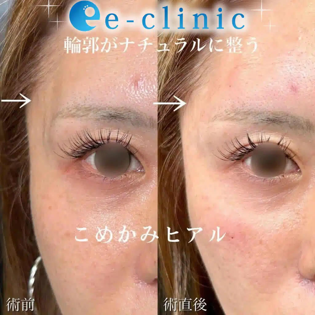 こめかみ ヒアルロン酸