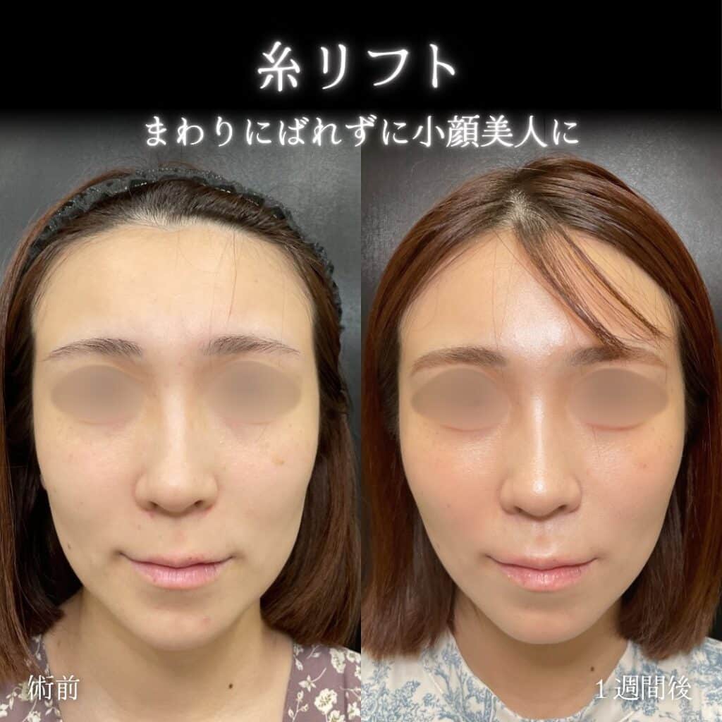 糸リフトの症例写真