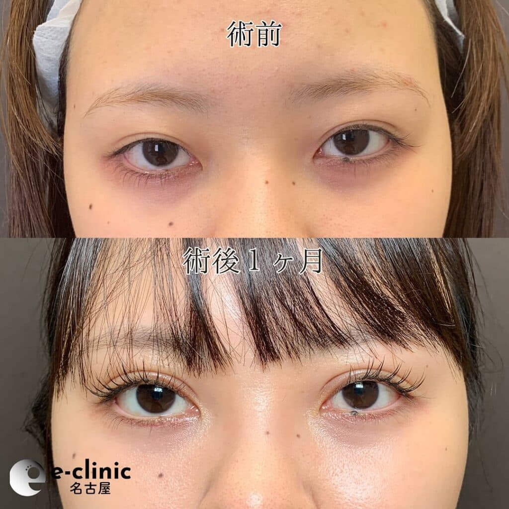 eclinic東京院の全切開二重術