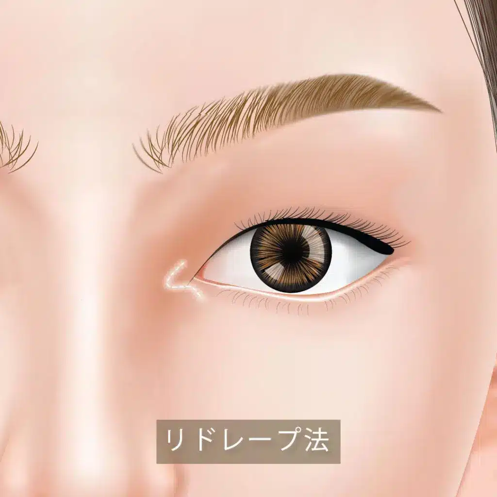 目頭切開_リドレープ形成