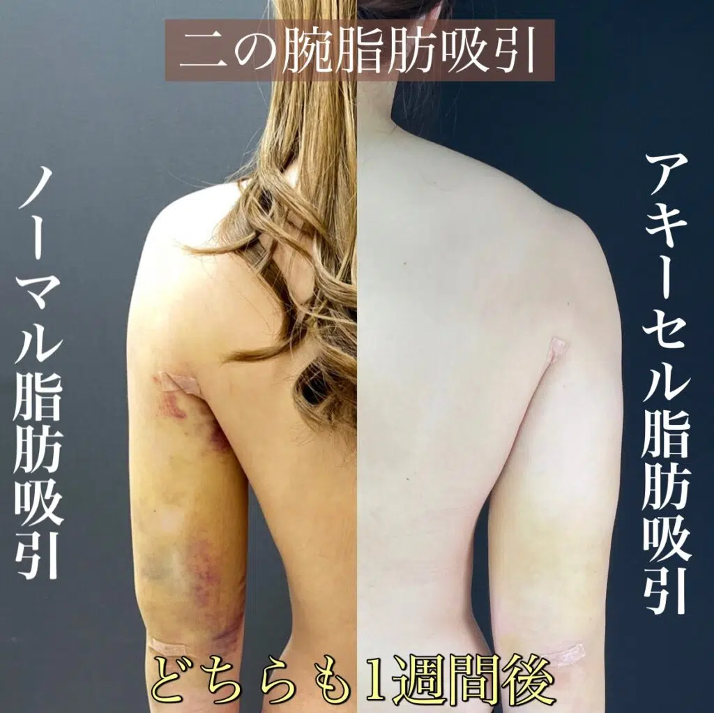 アキーセル脂肪吸引 東京