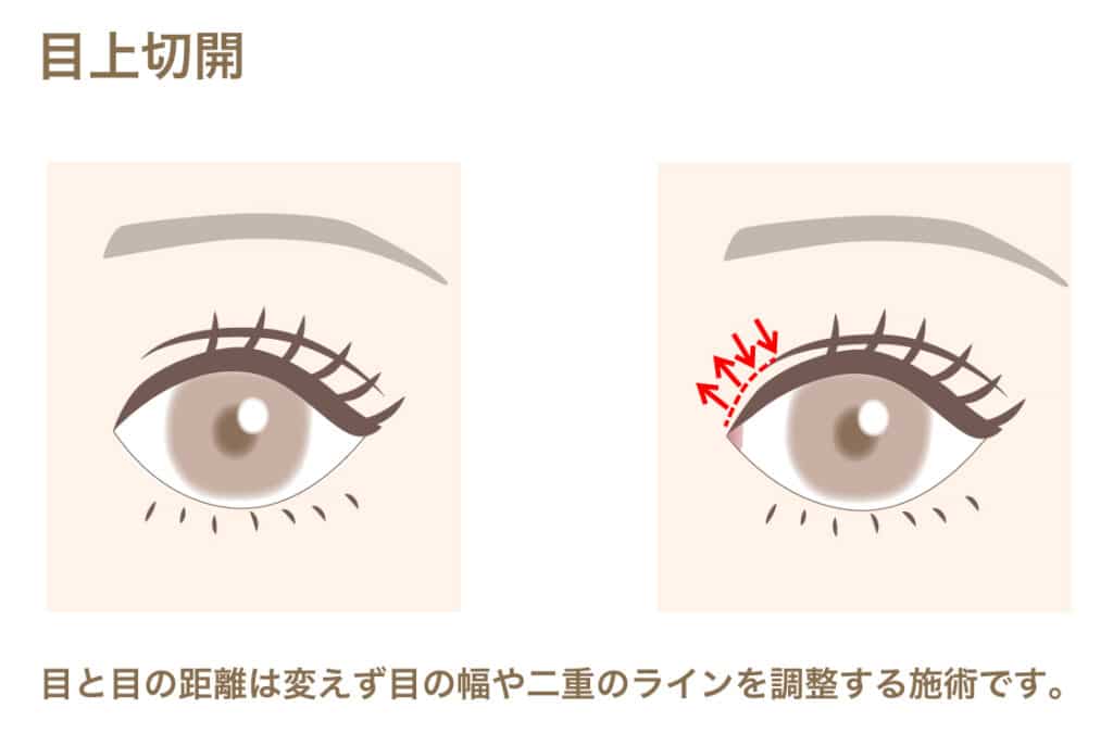 目上切開の説明をしている画像