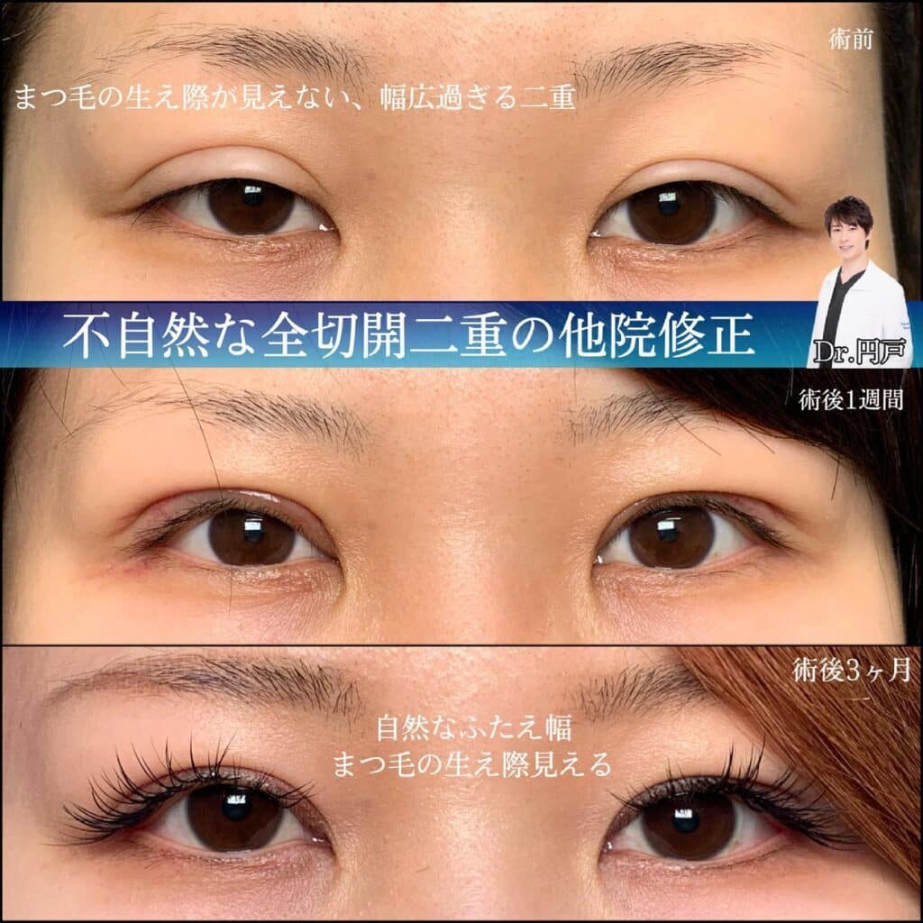 eclinic東京院の全切開二重術の他院修正