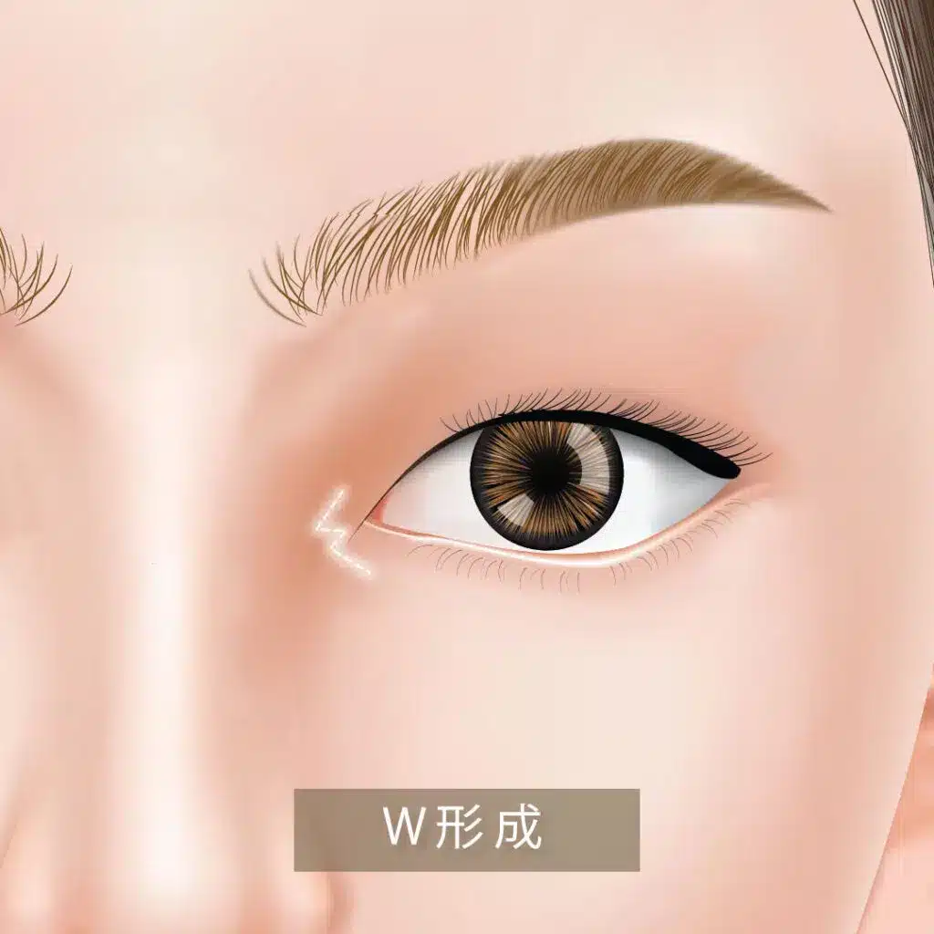 目頭切開_w形成