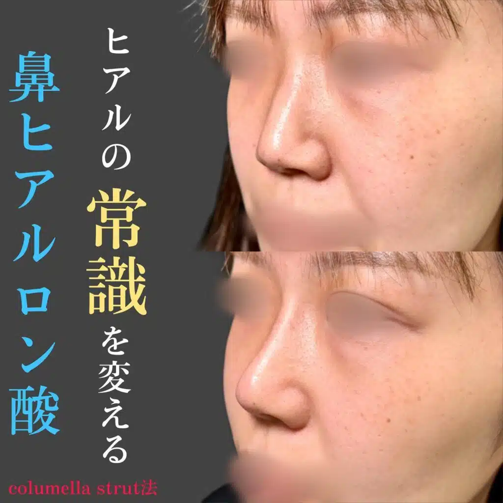 鼻 ヒアルロン酸