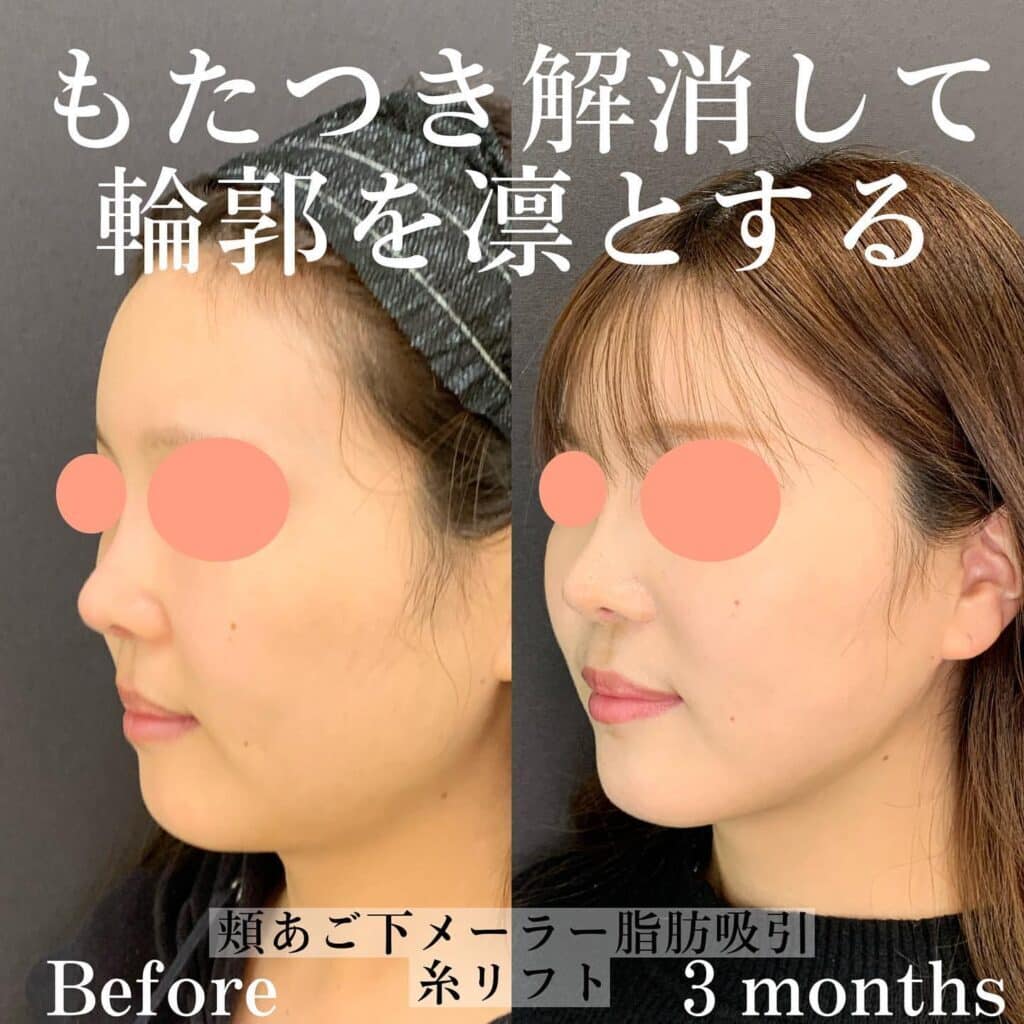 頬あご下メーラー脂肪吸引＋糸リフトの症例写真