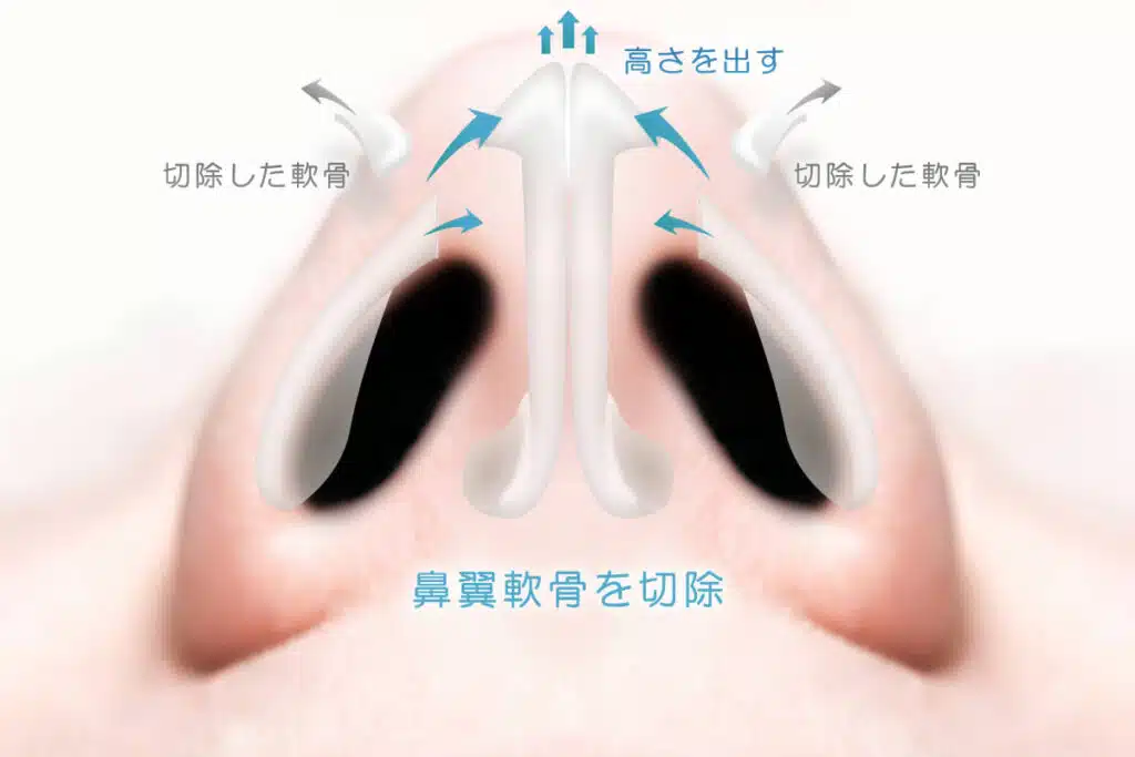 鼻尖形成