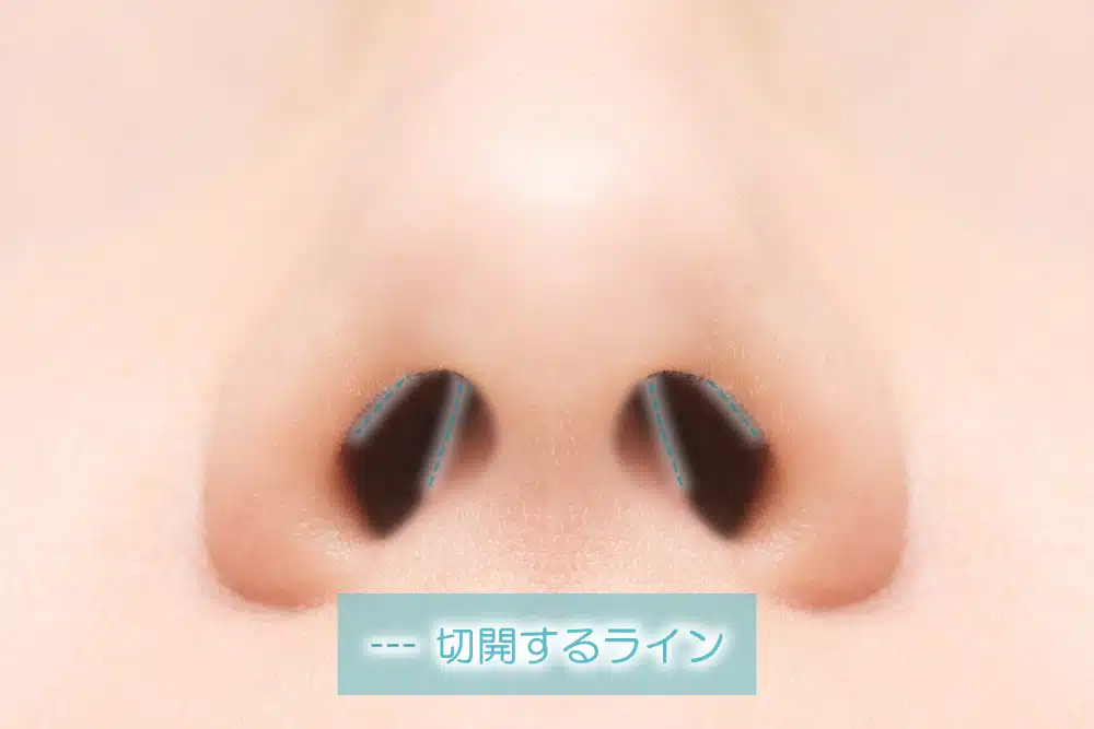 鼻尖形成
