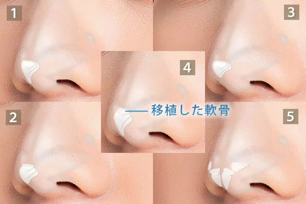 鼻尖形成