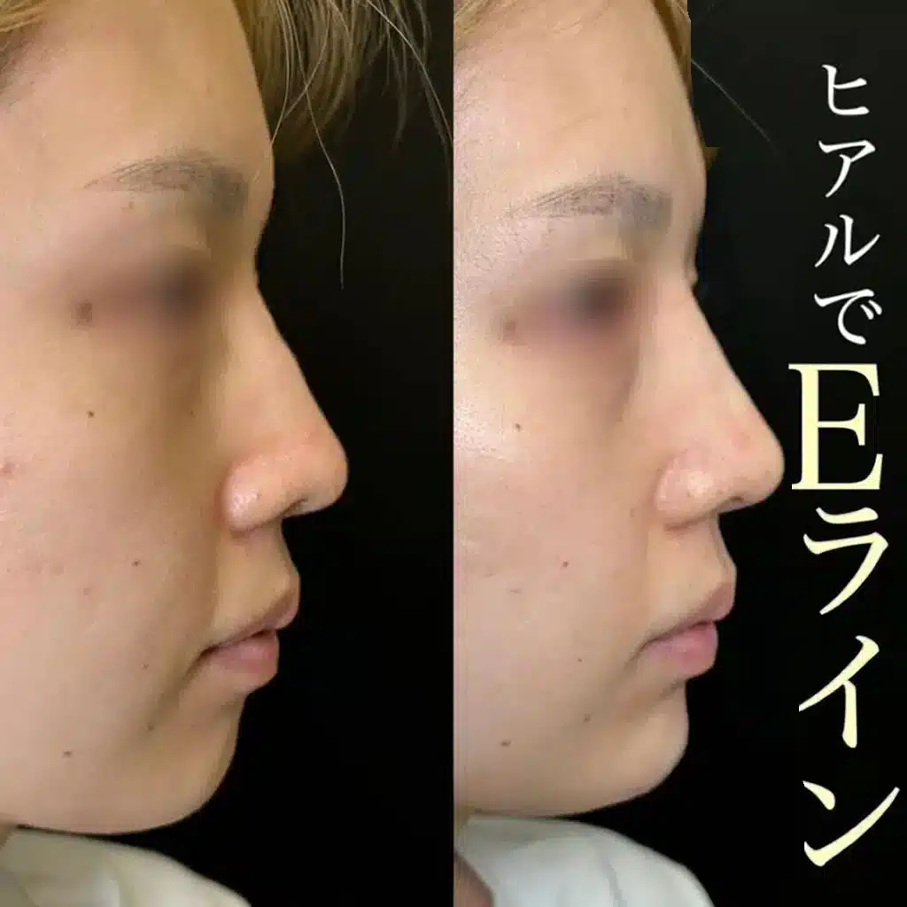ヒアルロン酸