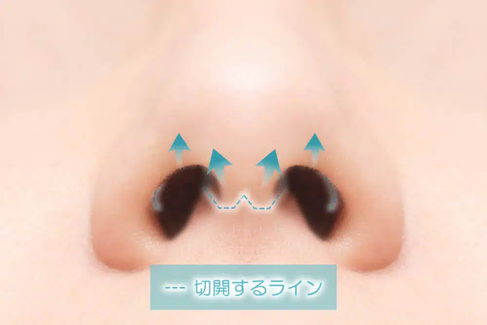 鼻尖形成