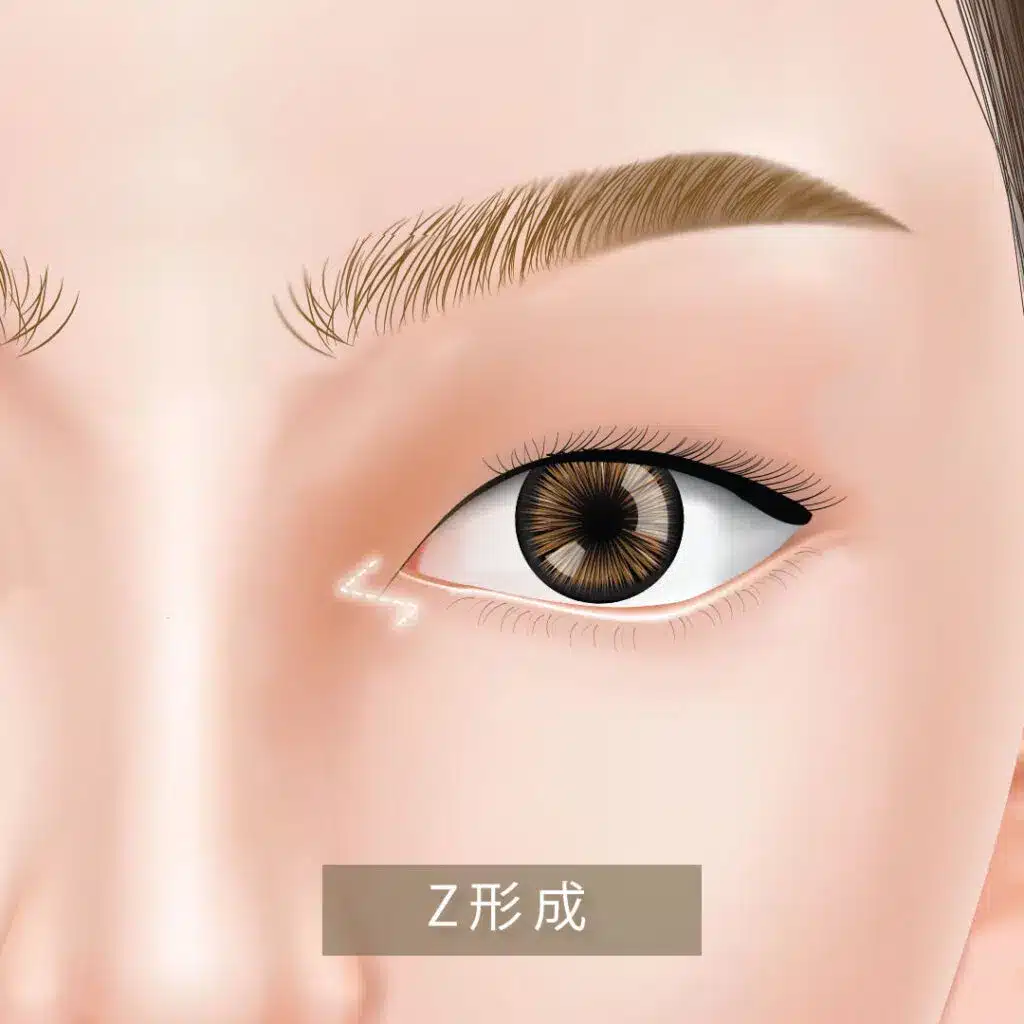 目頭切開_z形成