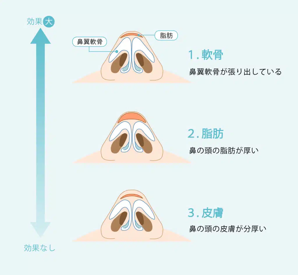鼻尖形成