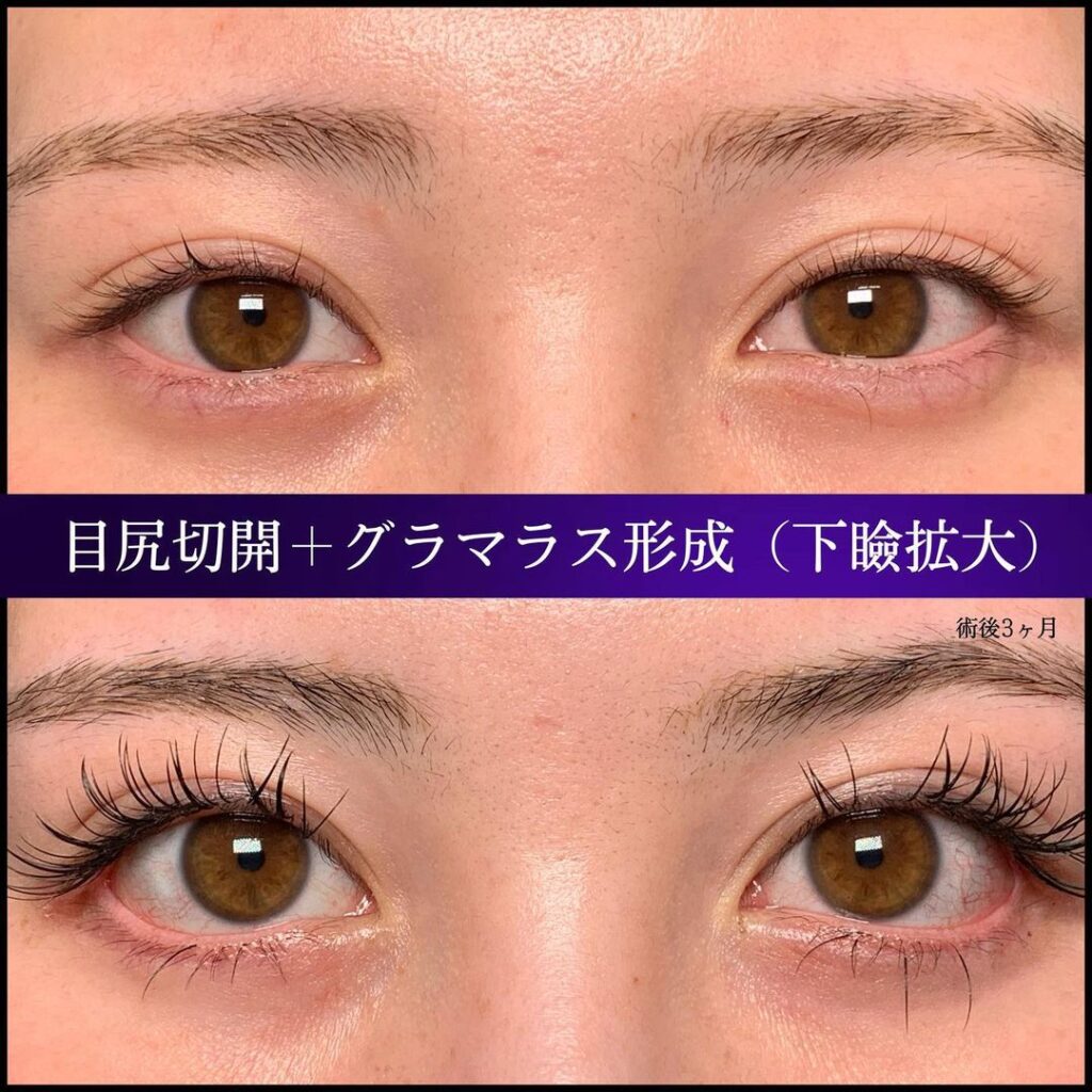 目尻切開+グラマラス形成の症例事例
