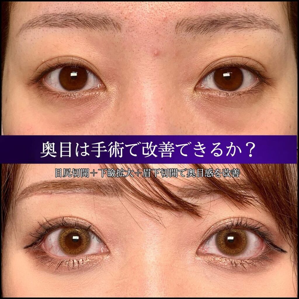 目尻切開+下瞼拡大+眉下切開の症例事例