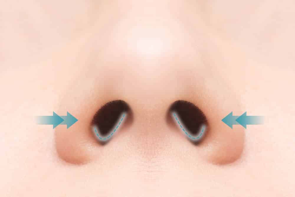 鼻腔内切開の図解