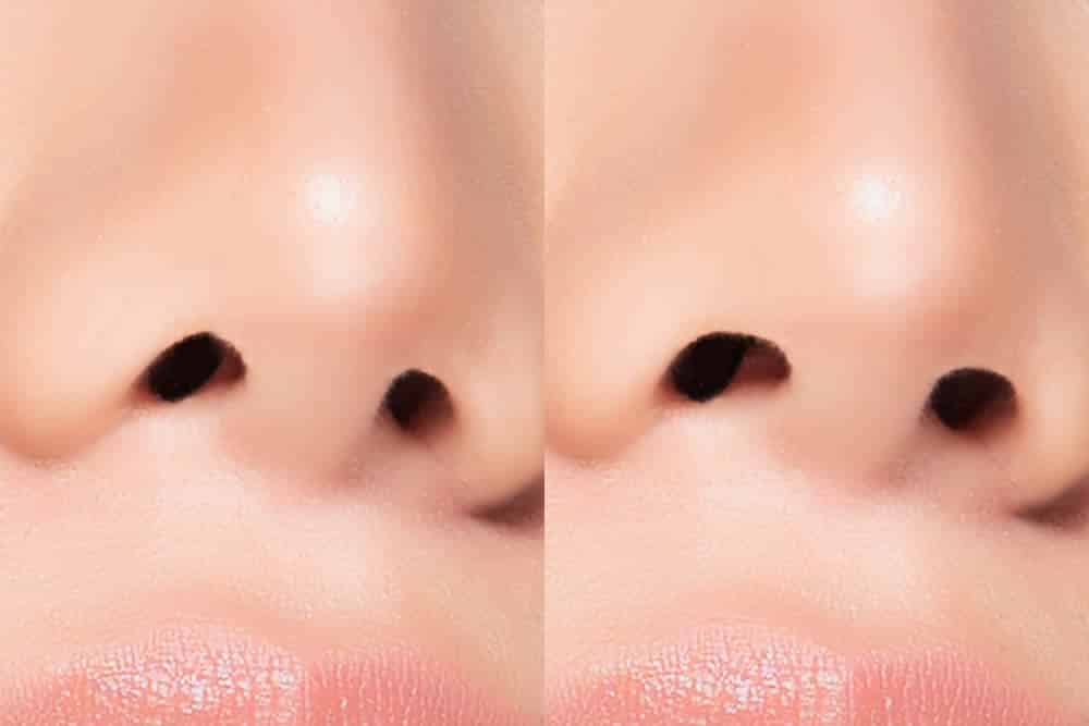 鼻孔縁挙上術の症例のイメージ