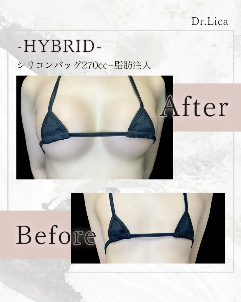eクリニック東京院のハイブリッド豊胸（シリコン＋コンデンス）（名医の田中里佳医師が執刀）