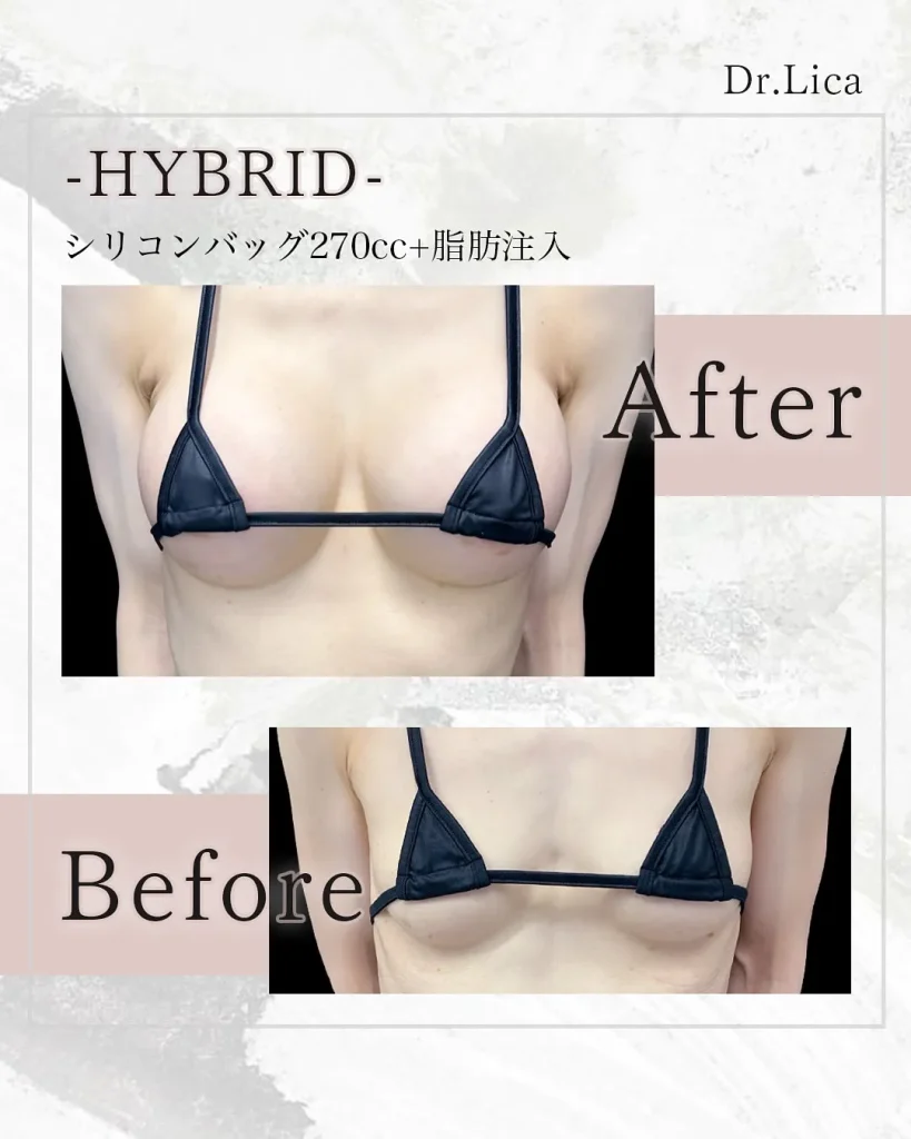 eクリニック東京院のハイブリッド豊胸（シリコン＋コンデンス）（名医の田中里佳医師が執刀）