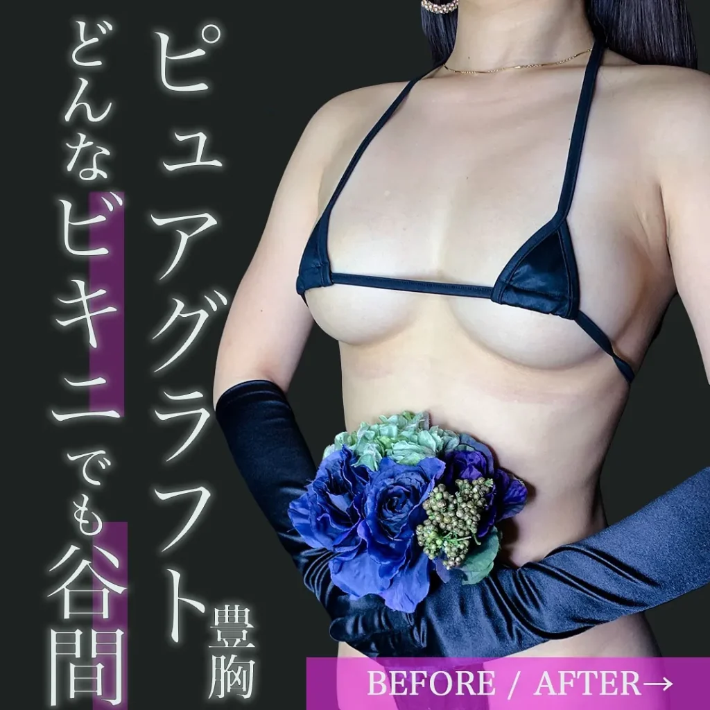 eクリニック東京院のピュアグラフト豊胸（名医の田中里佳医師が執刀）