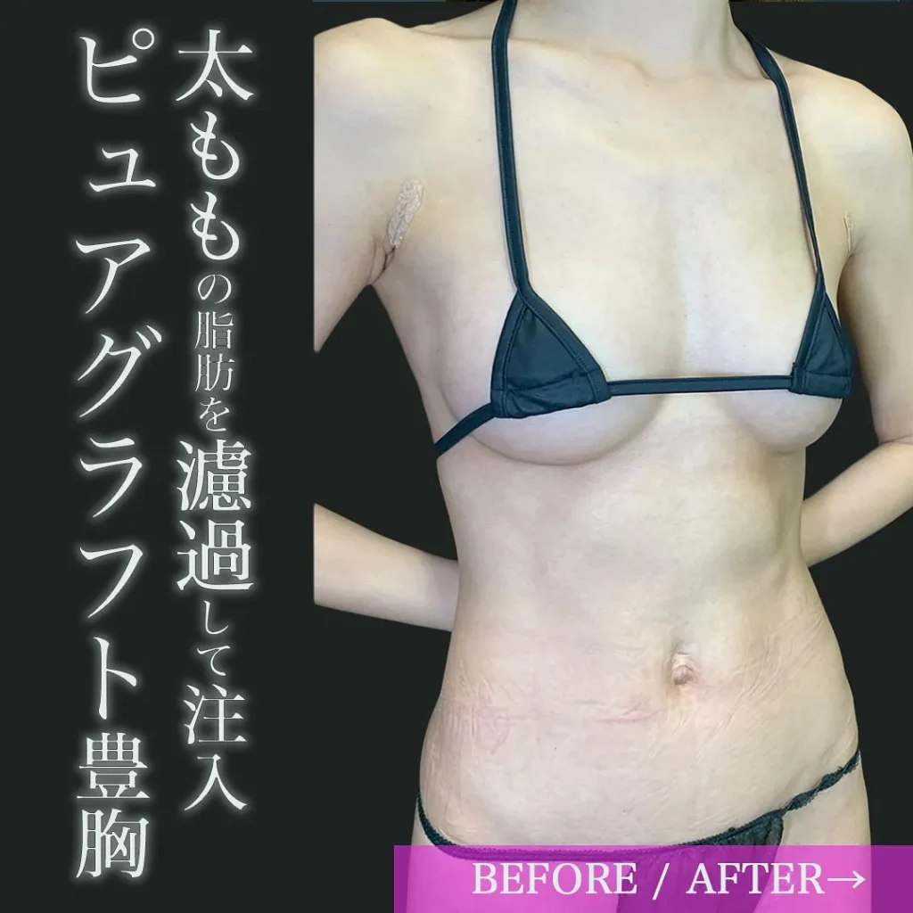 eクリニック東京院のピュアグラフト豊胸（名医の田中里佳医師が執刀）