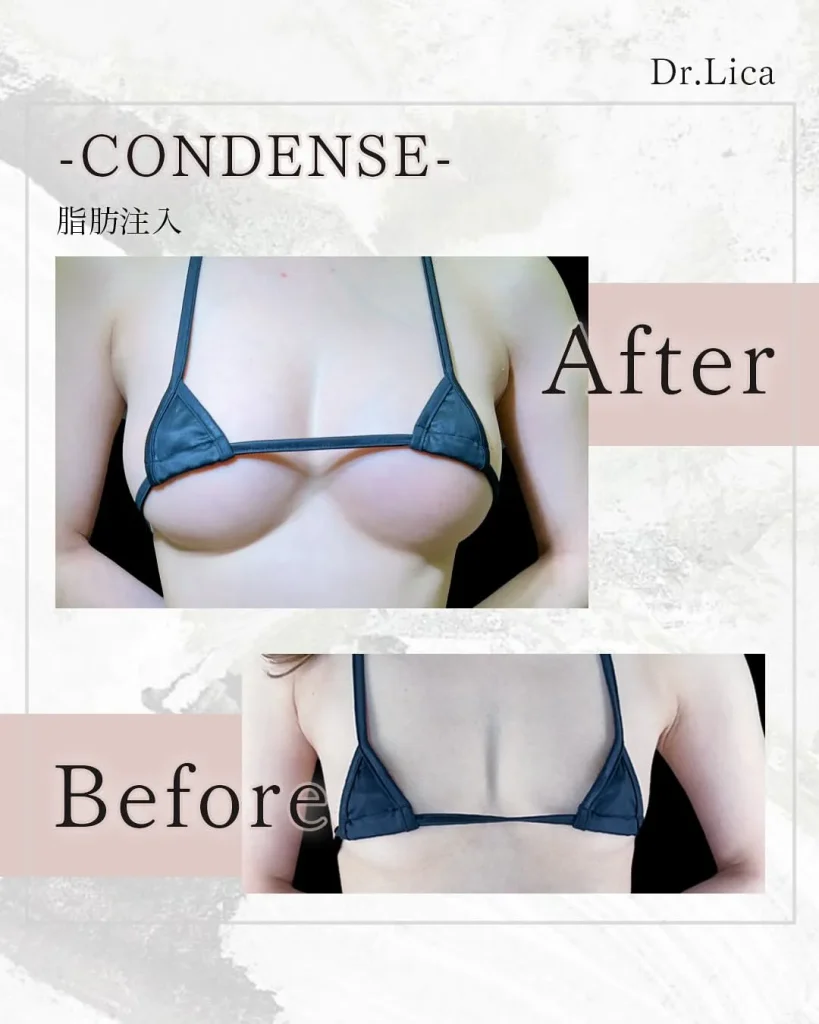 eクリニック東京院のコンデンス豊胸2回(名医の「田中里佳医師が執刀)