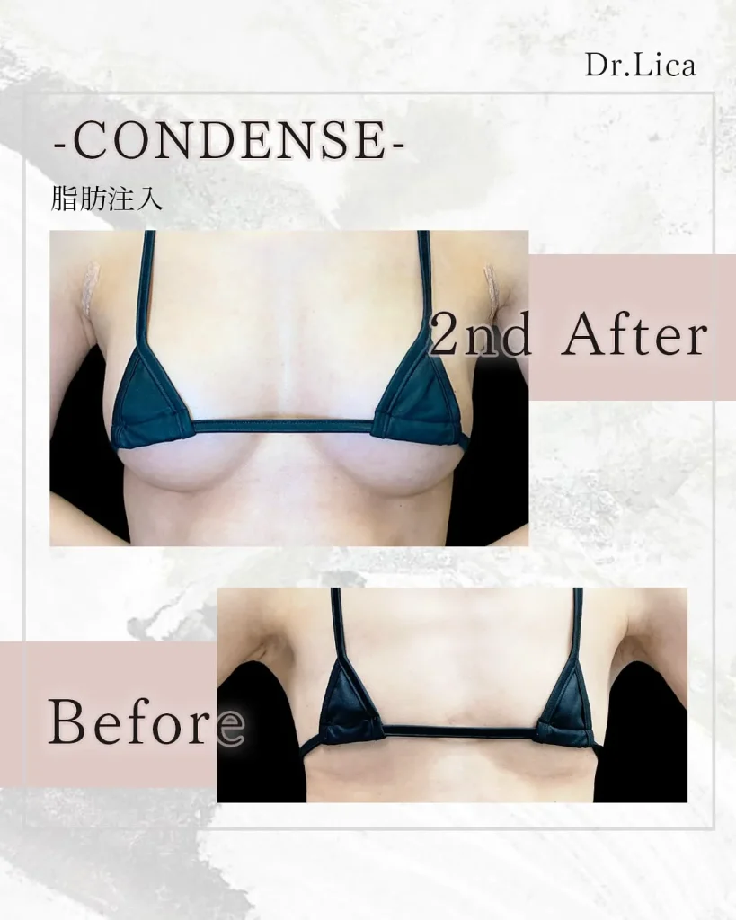 eクリニック東京院のピュアグラフト豊胸(1回目)+コンデンス豊胸(2回目)(名医の田中里佳医師が執刀)