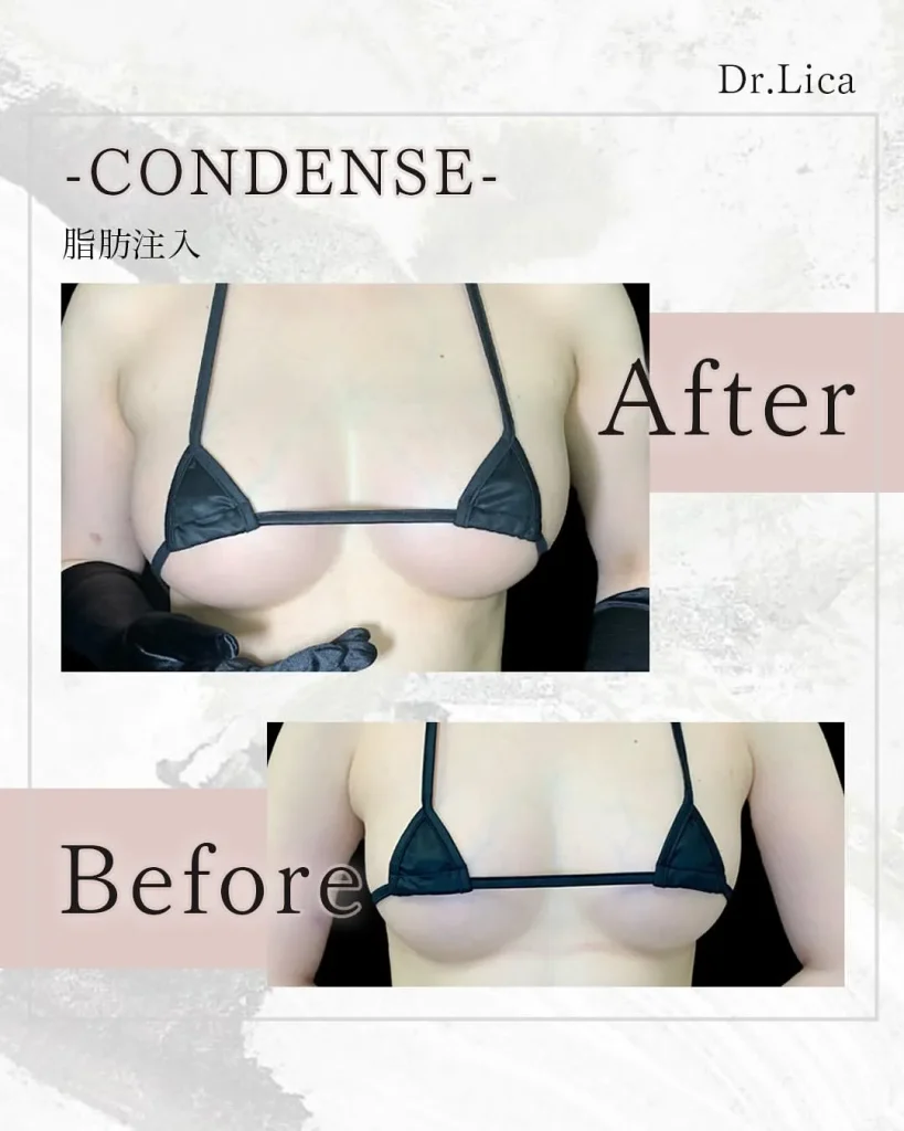 eクリニック東京院のコンデンス豊胸(名医の「田中里佳医師が執刀)