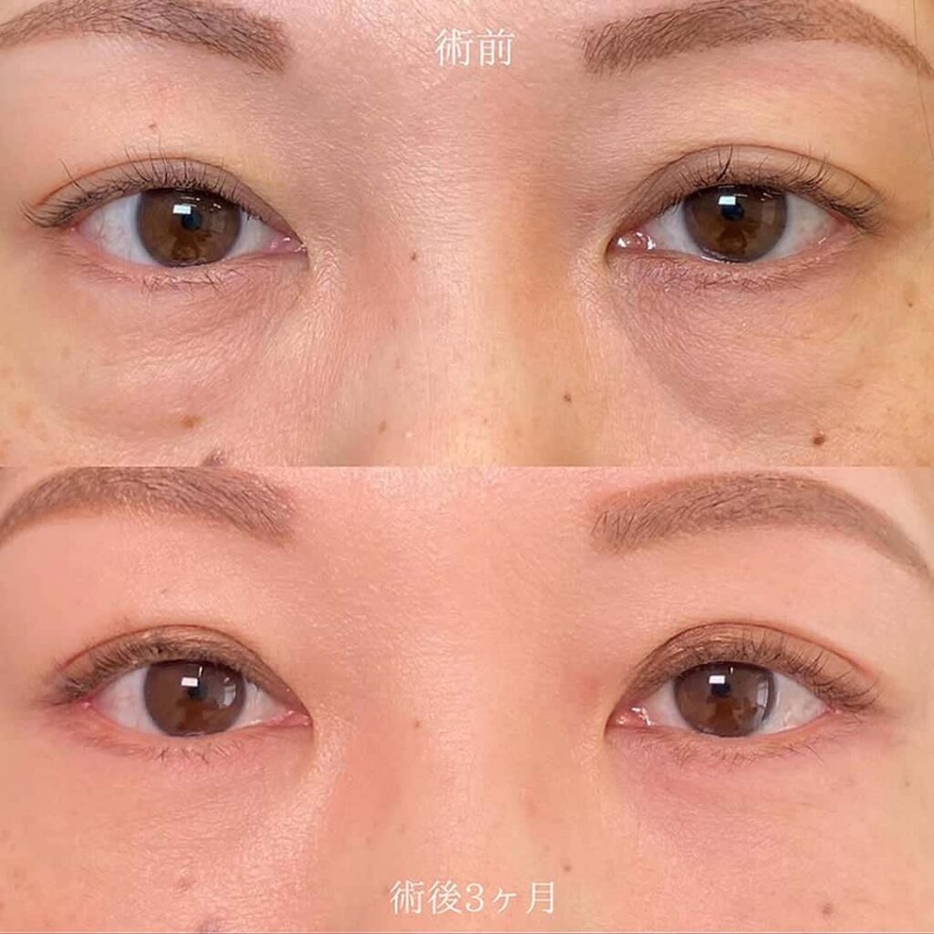 表ハムラの症例写真
