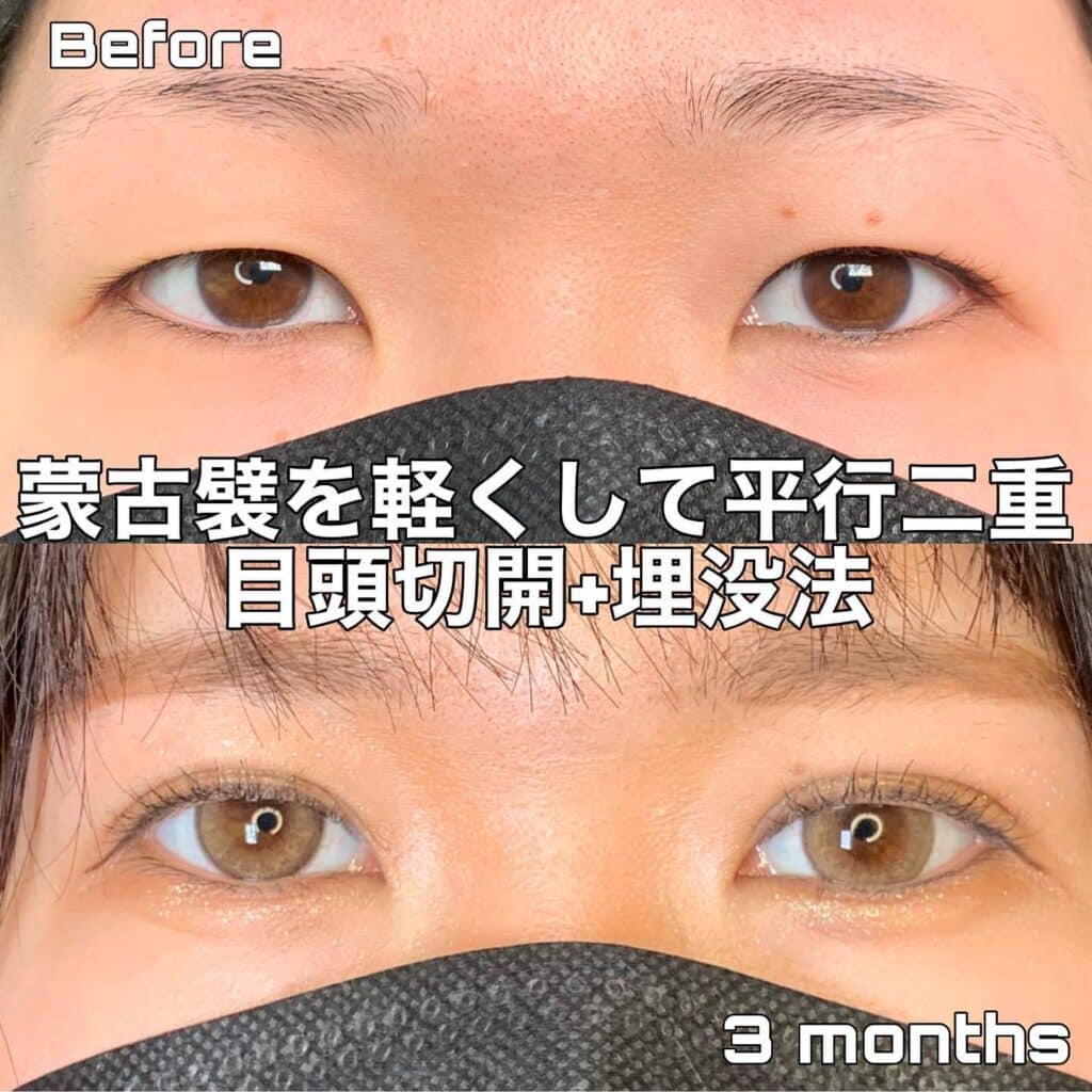 eclinic東京院の埋没法+目頭切開